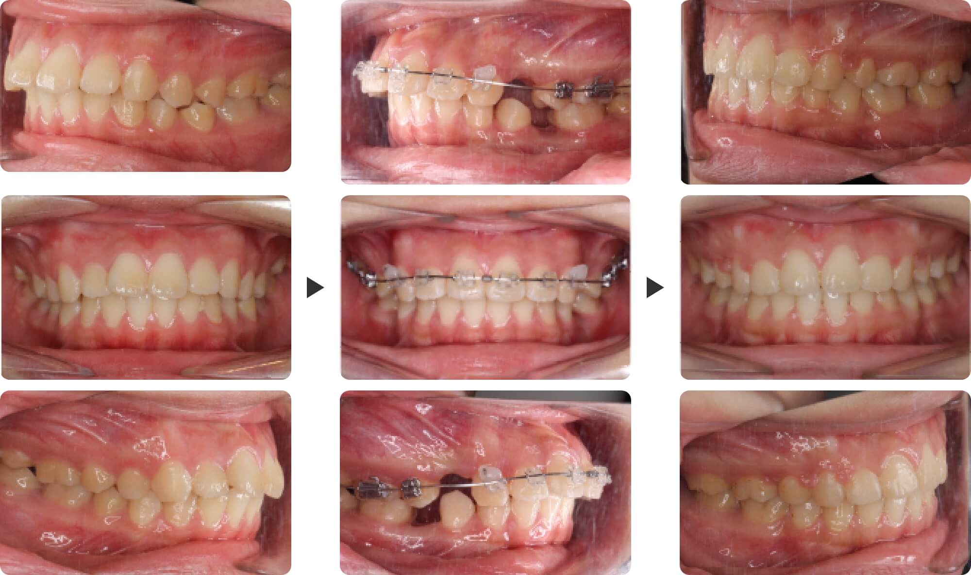 出っ歯(上顎前突)の症例