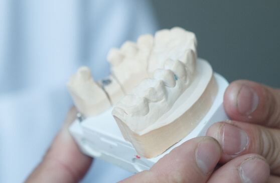治療後の歯並びのイメージ模型を作製