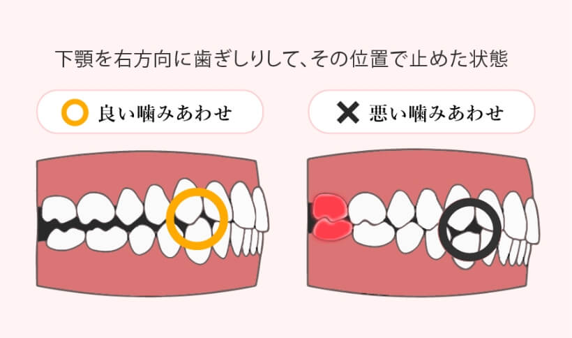 歯列矯正で歯の崩壊を防ぐ