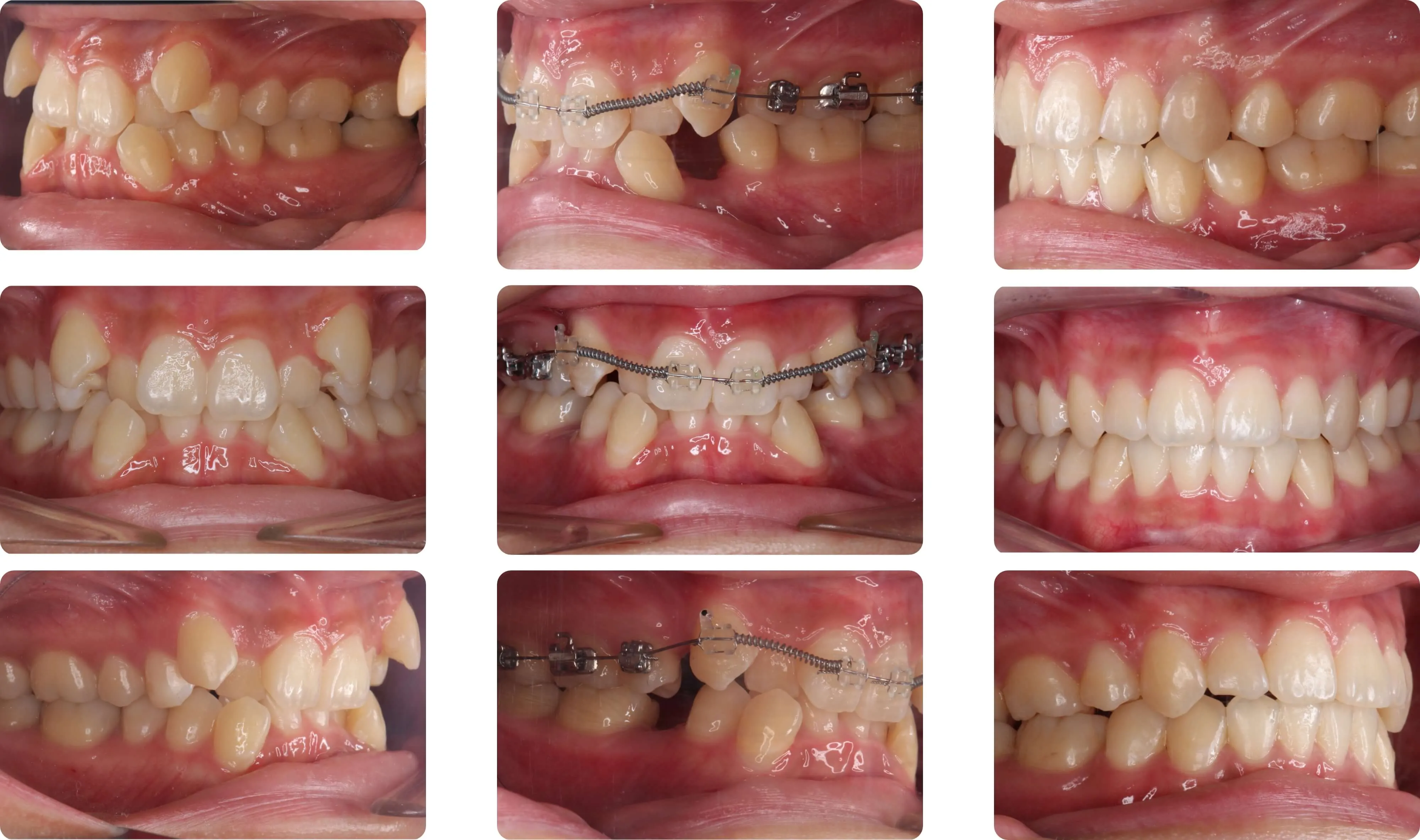 がたがた・でこぼこ（叢生）・八重歯の治療例｜大阪府枚方市の辻村矯正歯科